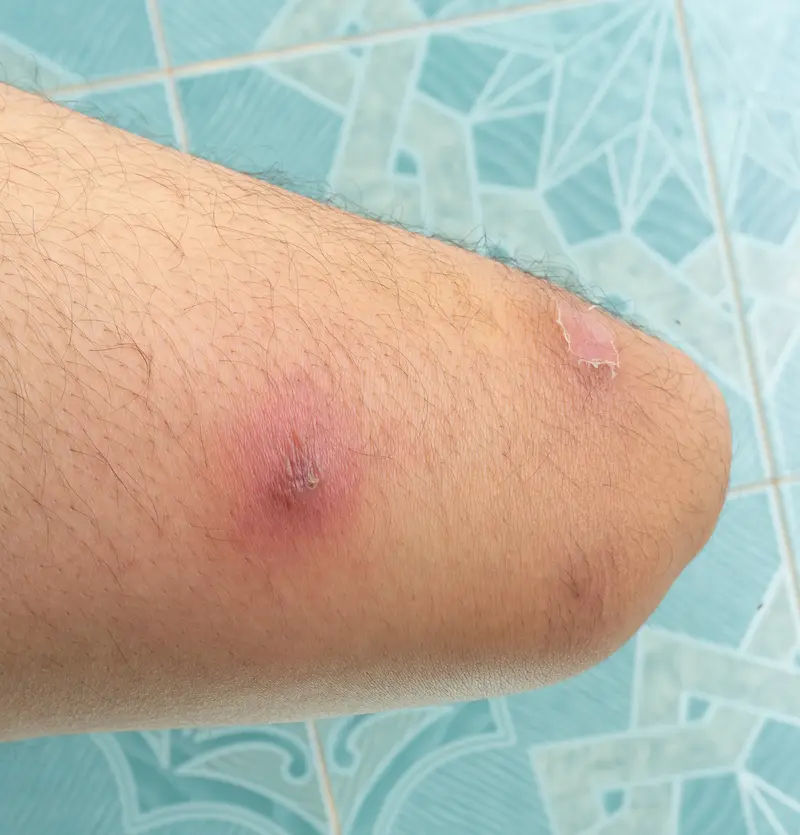 Abscess Symptoms, Causes, Treatment, and Types